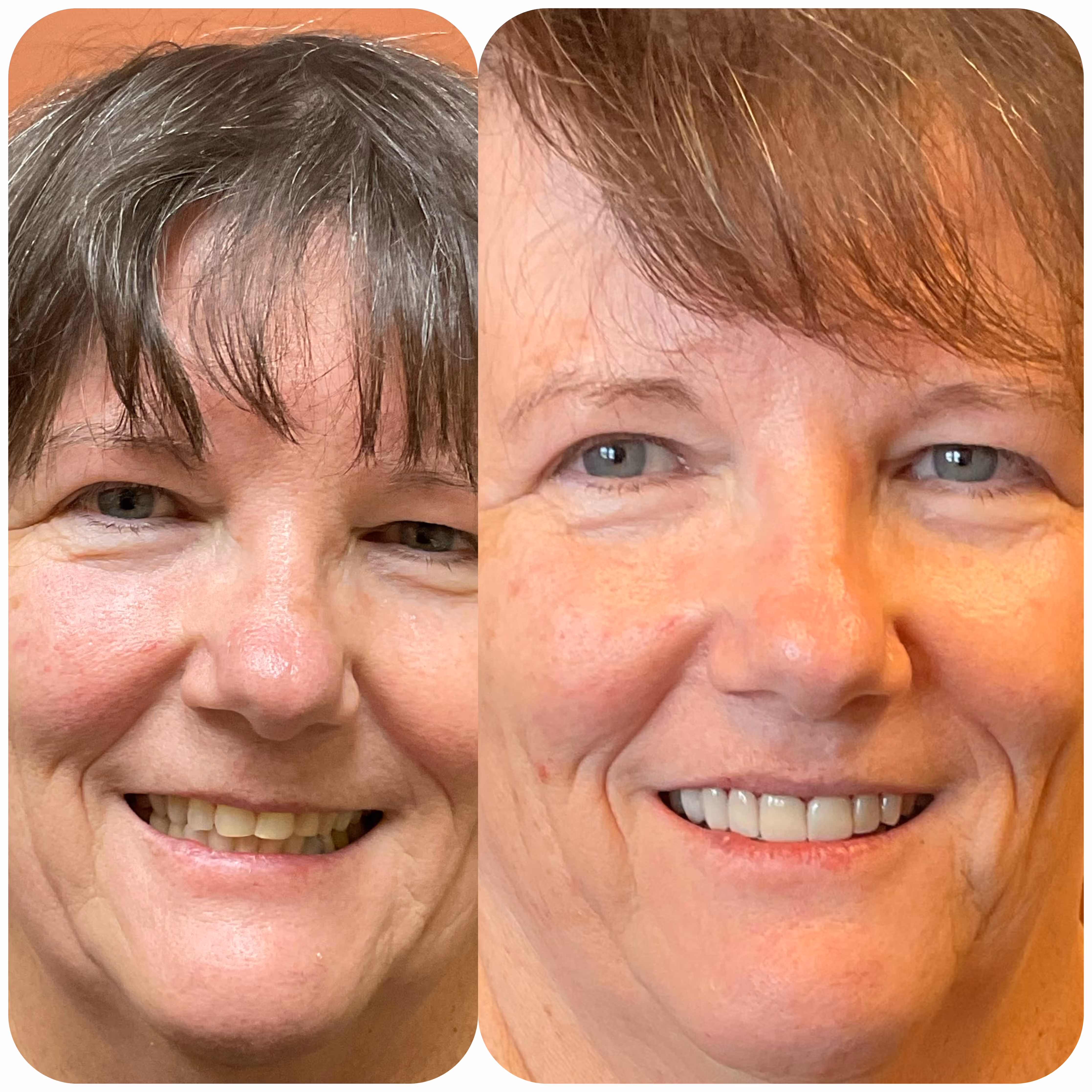 Dental Veneers