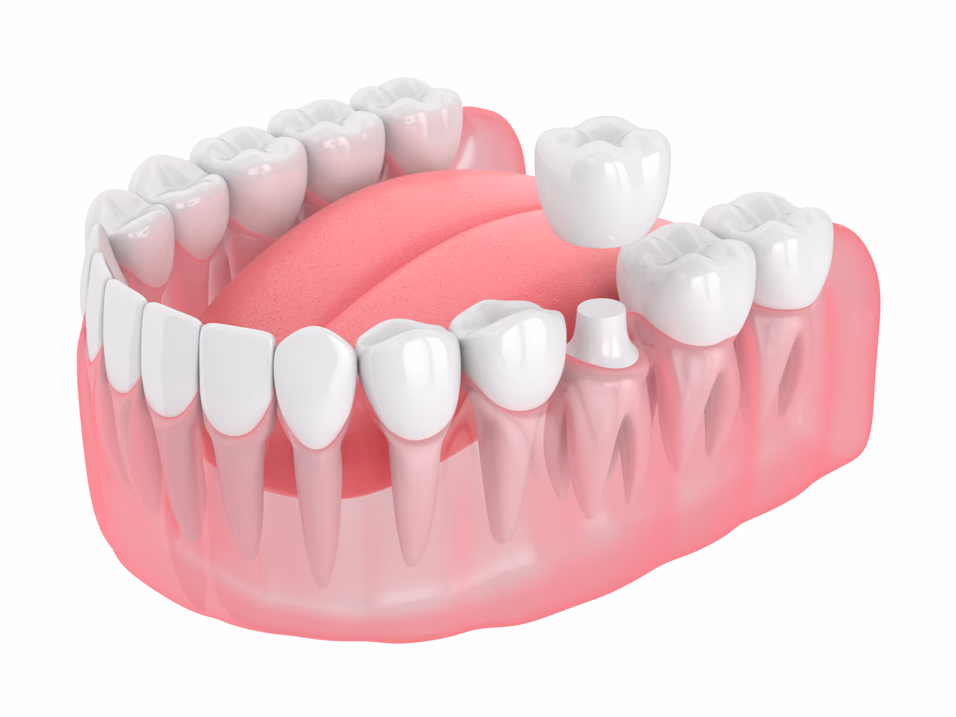 Dental Crowns