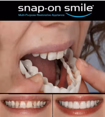 Snap-On Smile