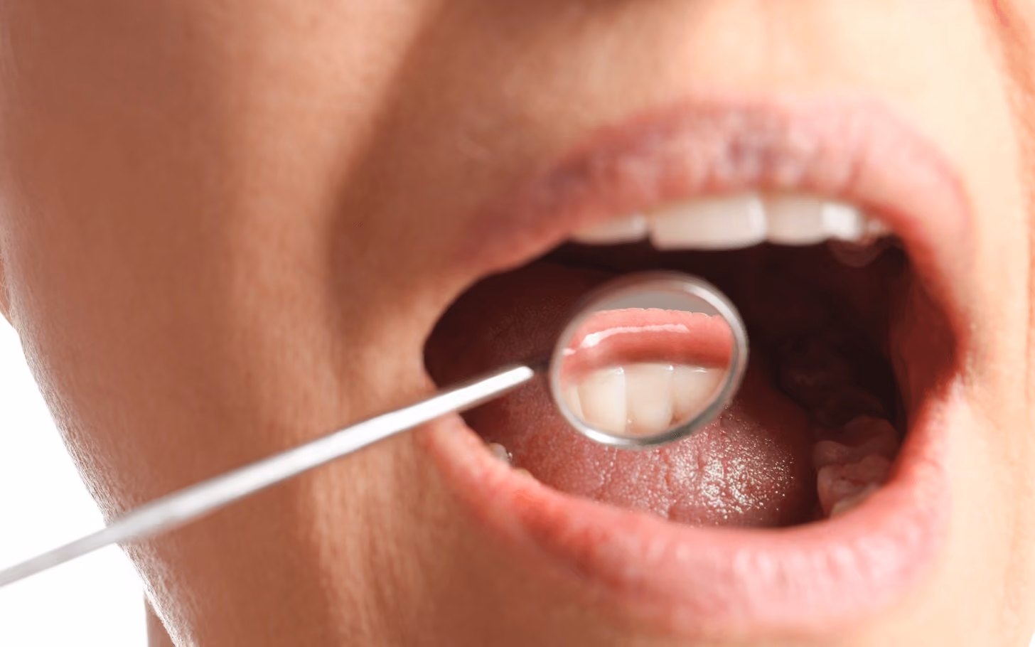 Close-up of a small dental mirror being used by a dentist to check the health of a patient’s gums at the best dentist in Los Gatos