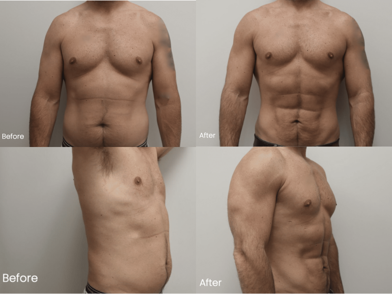 AB Etching Before and After