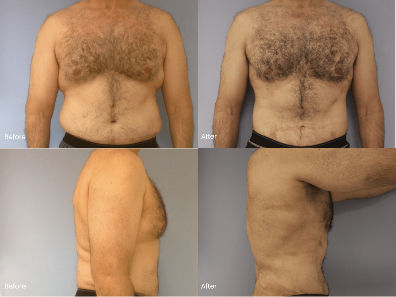 AB Etching Before and After
