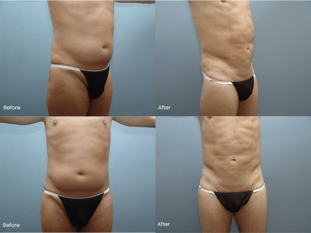 AB Etching Before and After