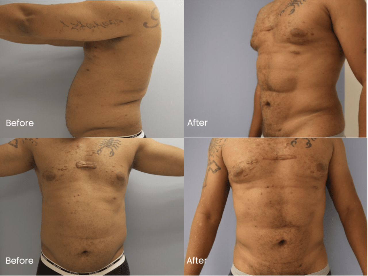 AB Etching Before and After