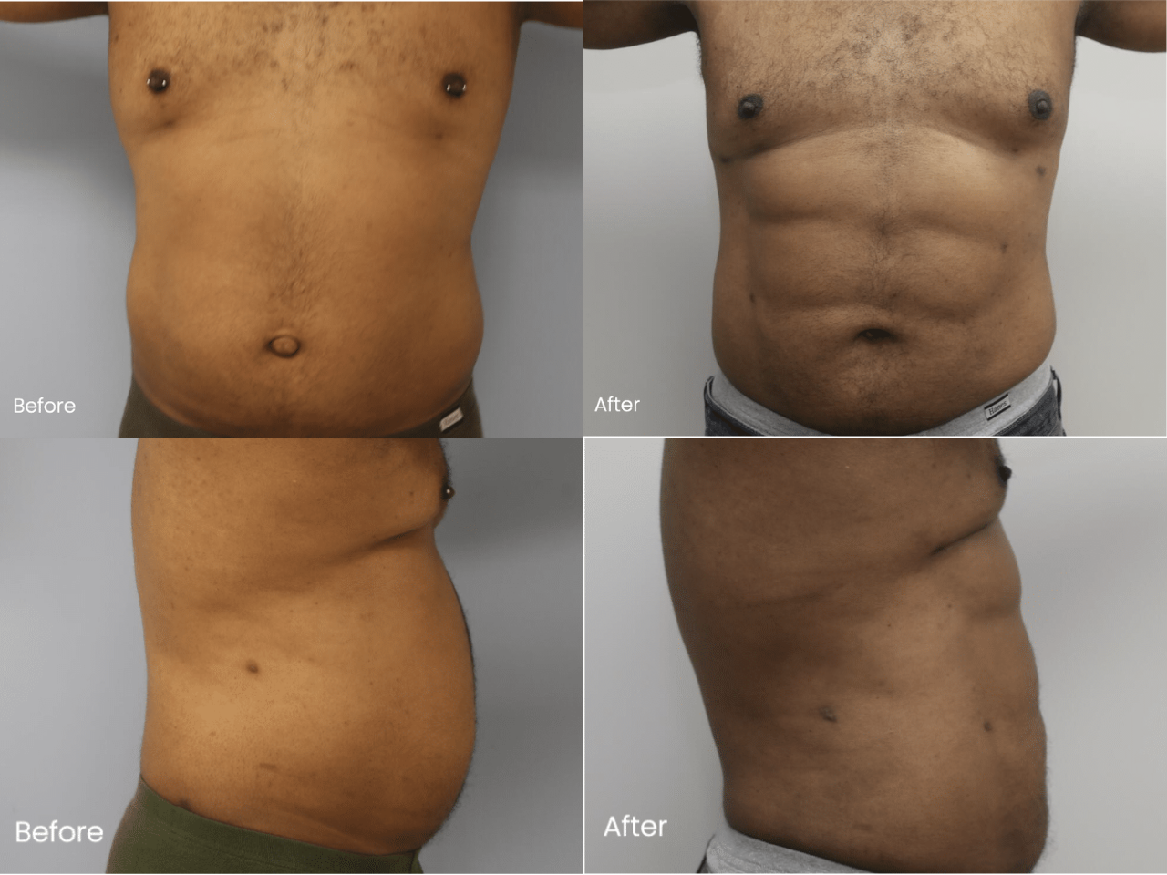 AB Etching Before and After