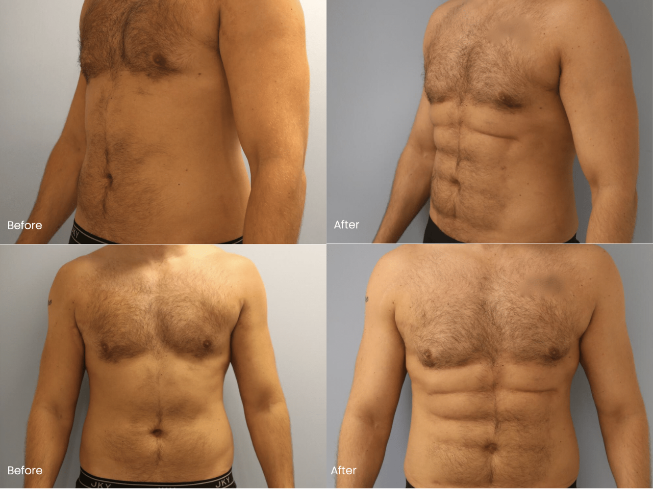 AB Etching Before and After