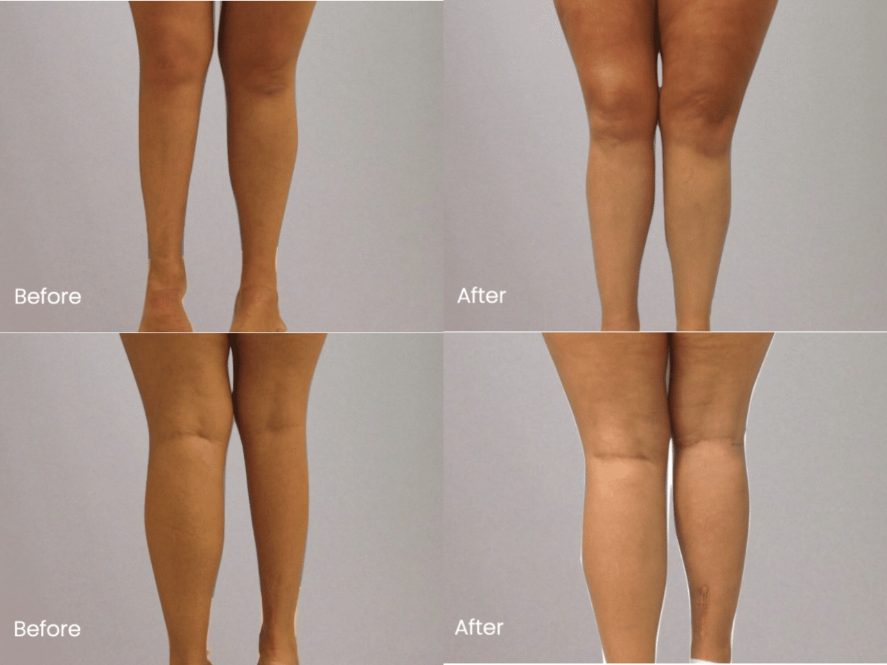 Calf Implant Before and After