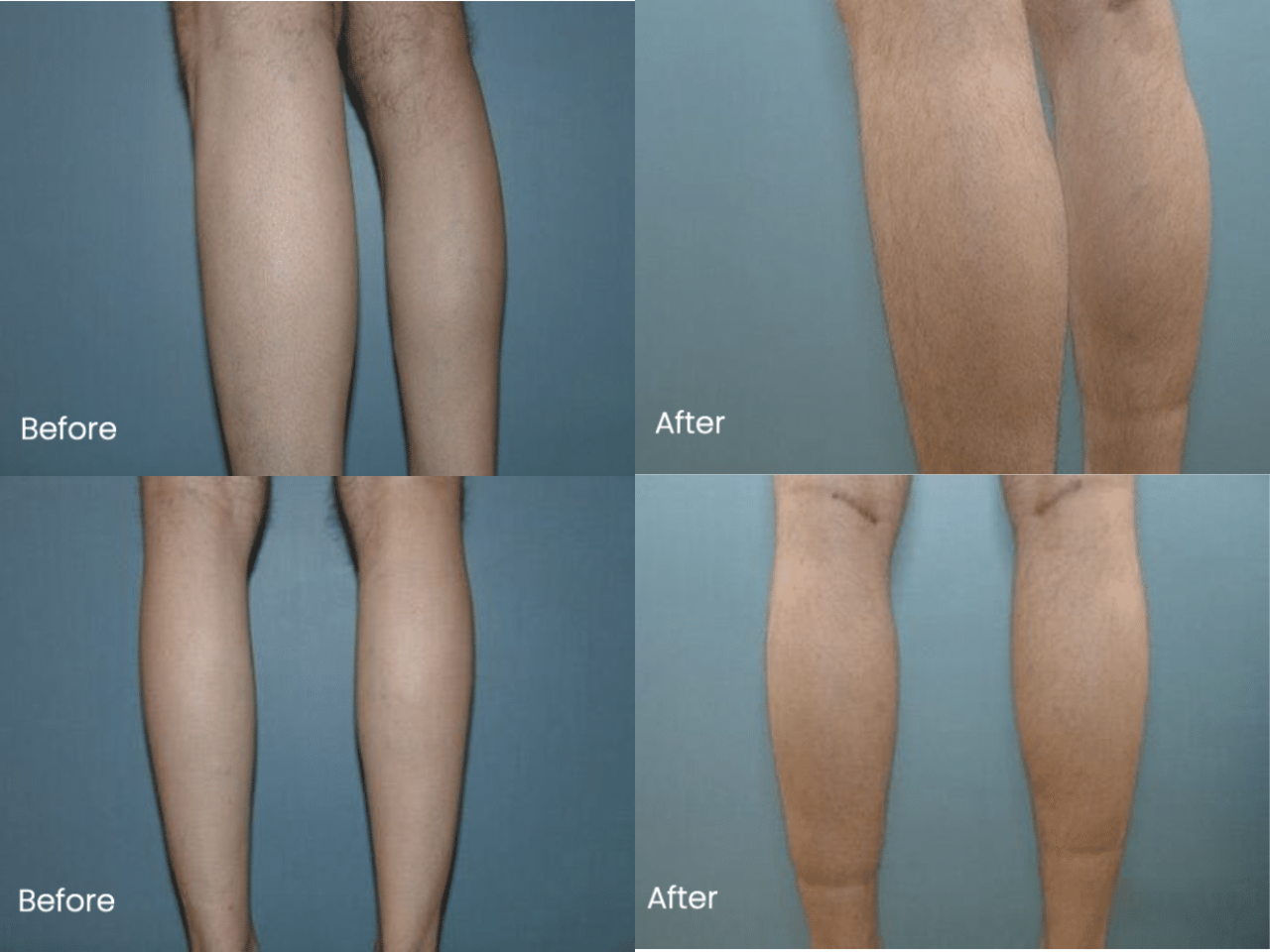 Calf Implant Before and After