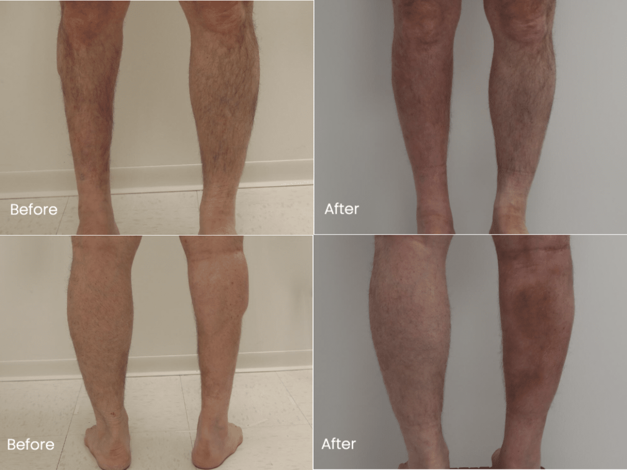 Calf Implant Before and After