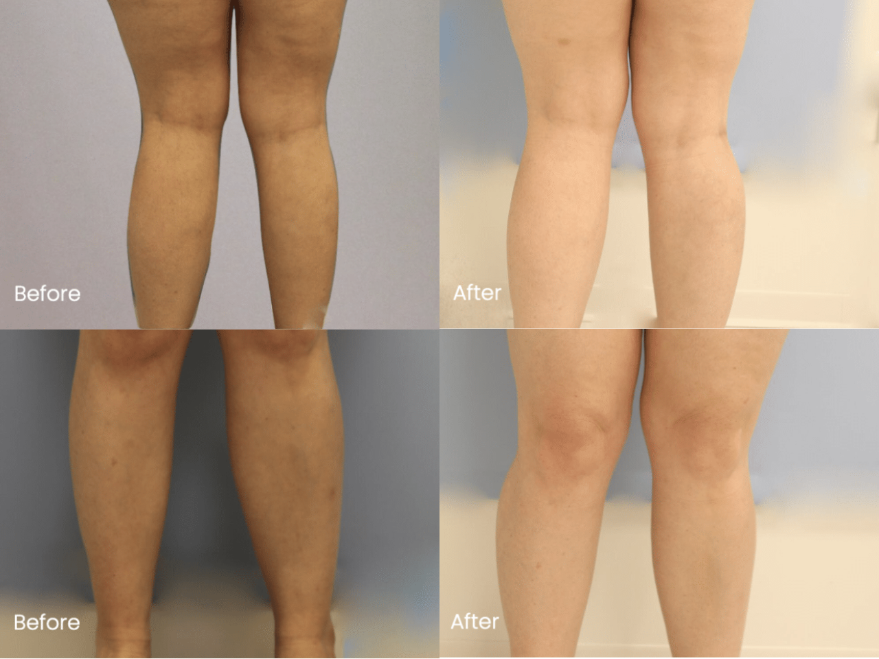 Calf Implant Before and After