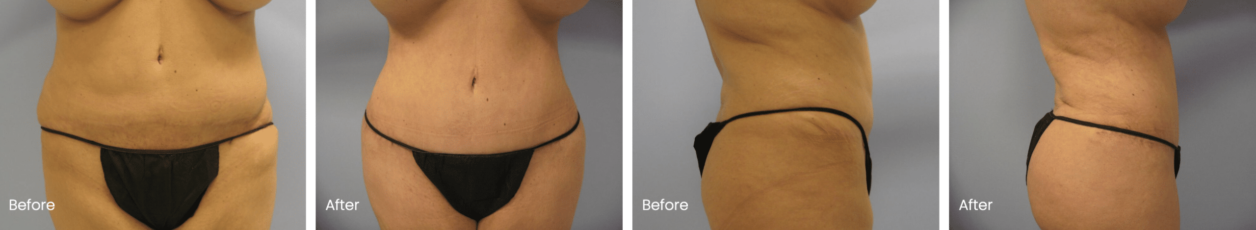 Revision Tummy Tuck Before and After