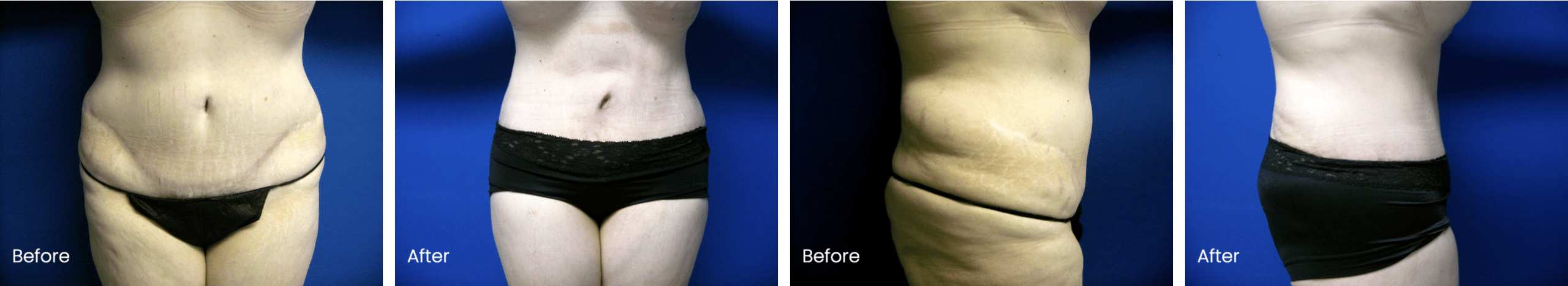 Revision Tummy Tuck Before and After