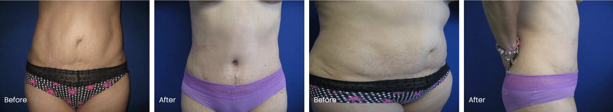 Revision Tummy Tuck Before and After

