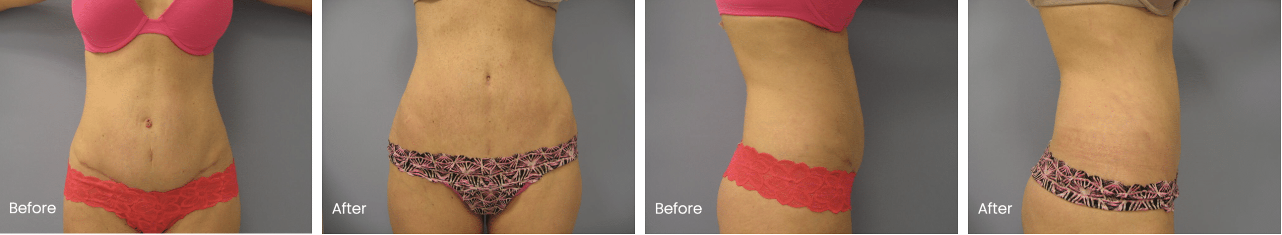 Revision Tummy Tuck Before and After