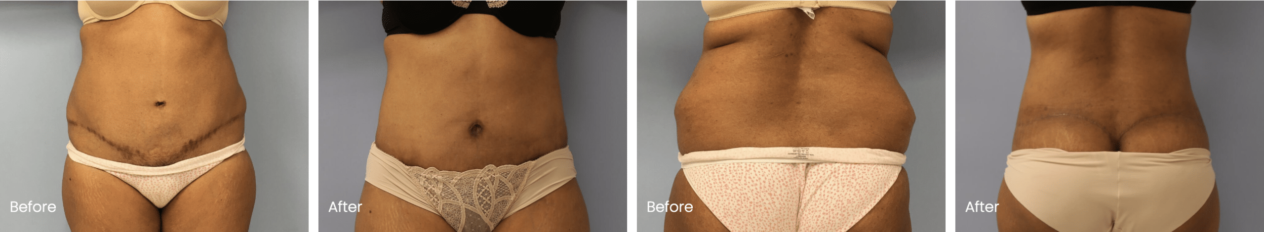 Revision Tummy Tuck Before and After