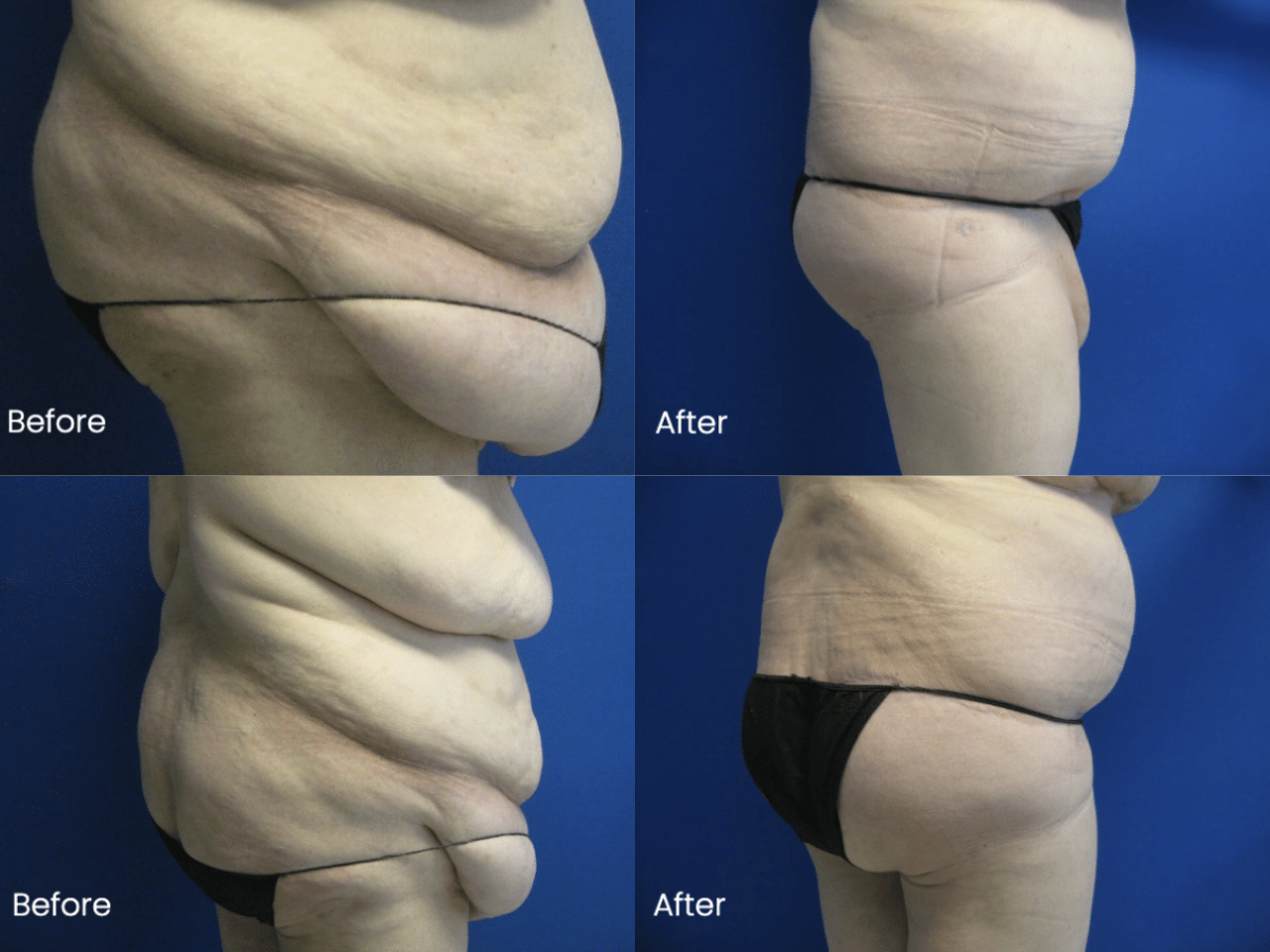 lower back lift before and after