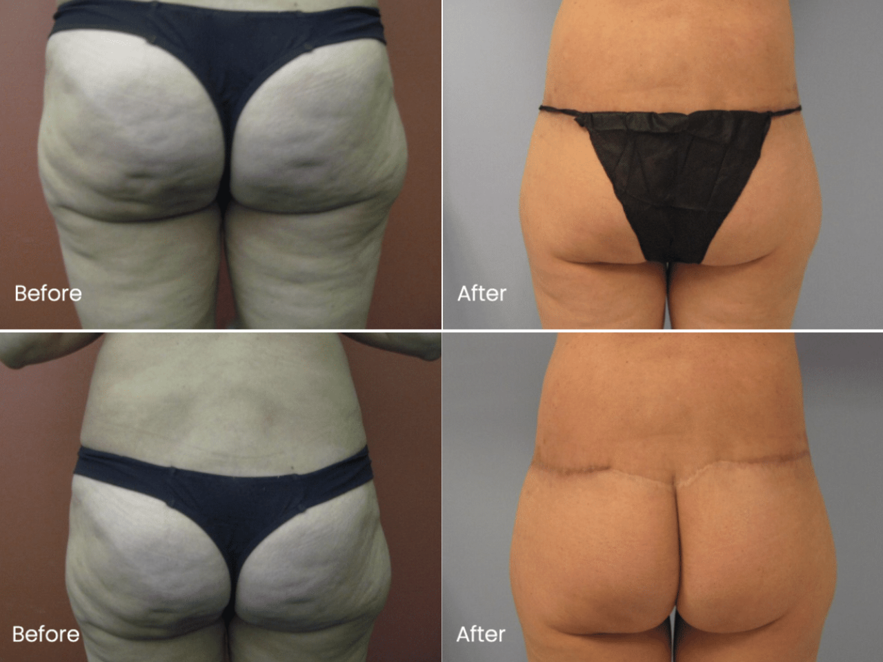 lower back lift before and after2