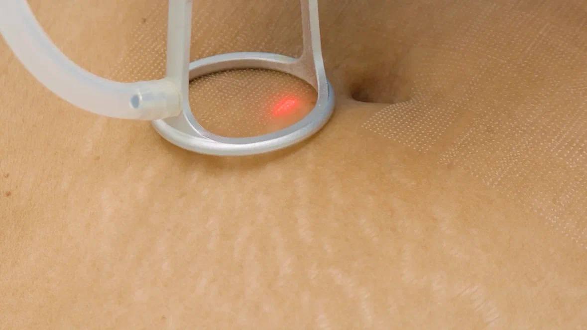 Фотоомоложение на аппарате IPL лазер Eunsung Global ClearLight