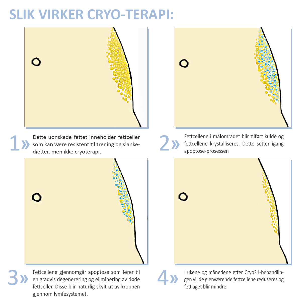 illstration of cryo threatment