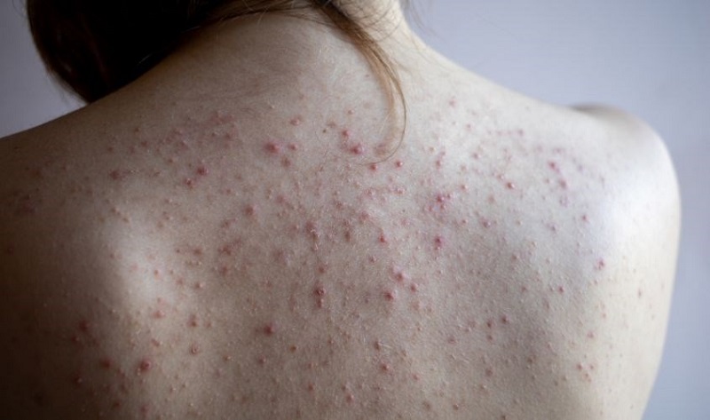 lưng mụn khi mang thai