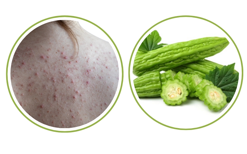 cách trị mụn lưng bằng khổ qua