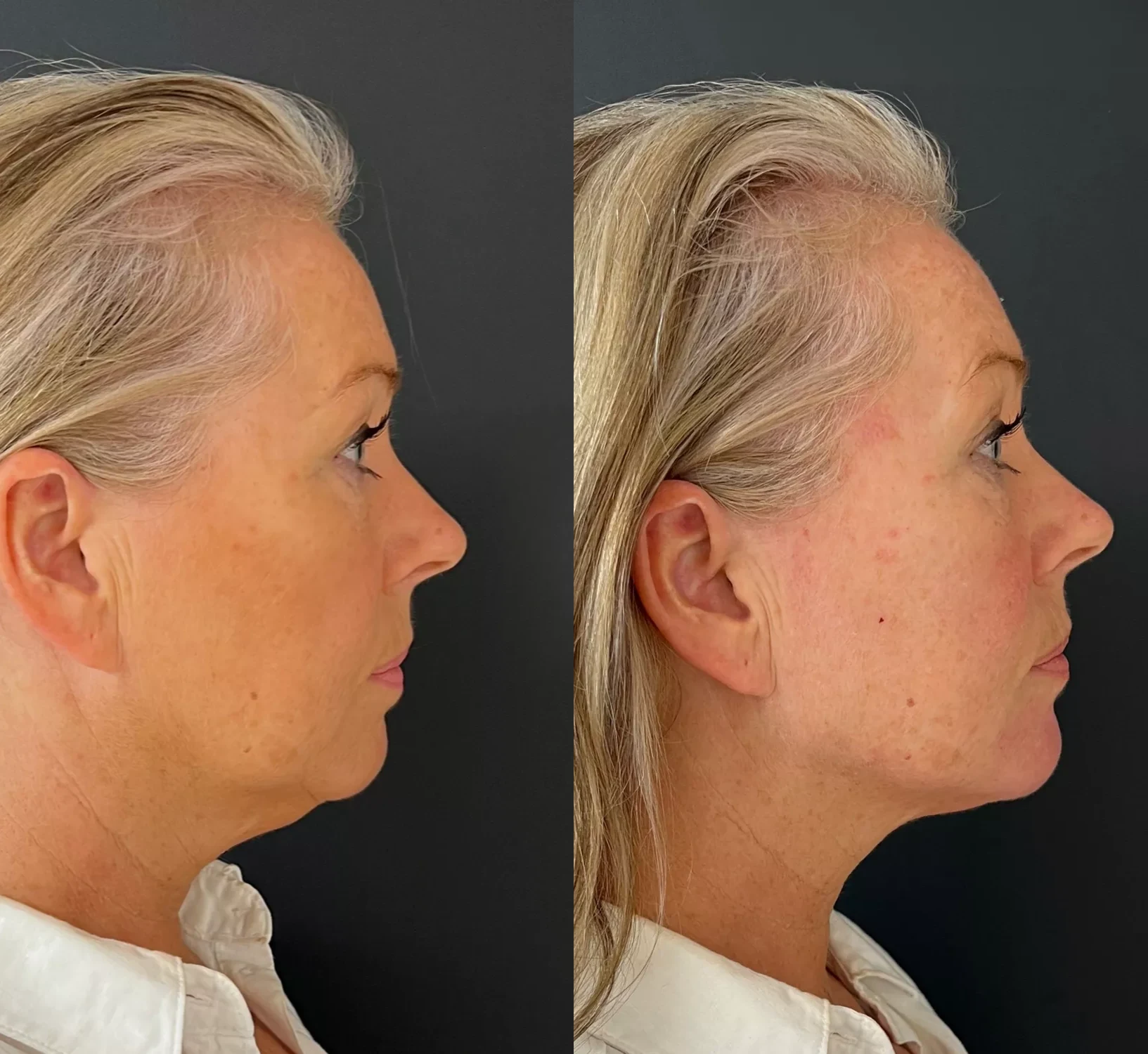Profhilo patient after treatment