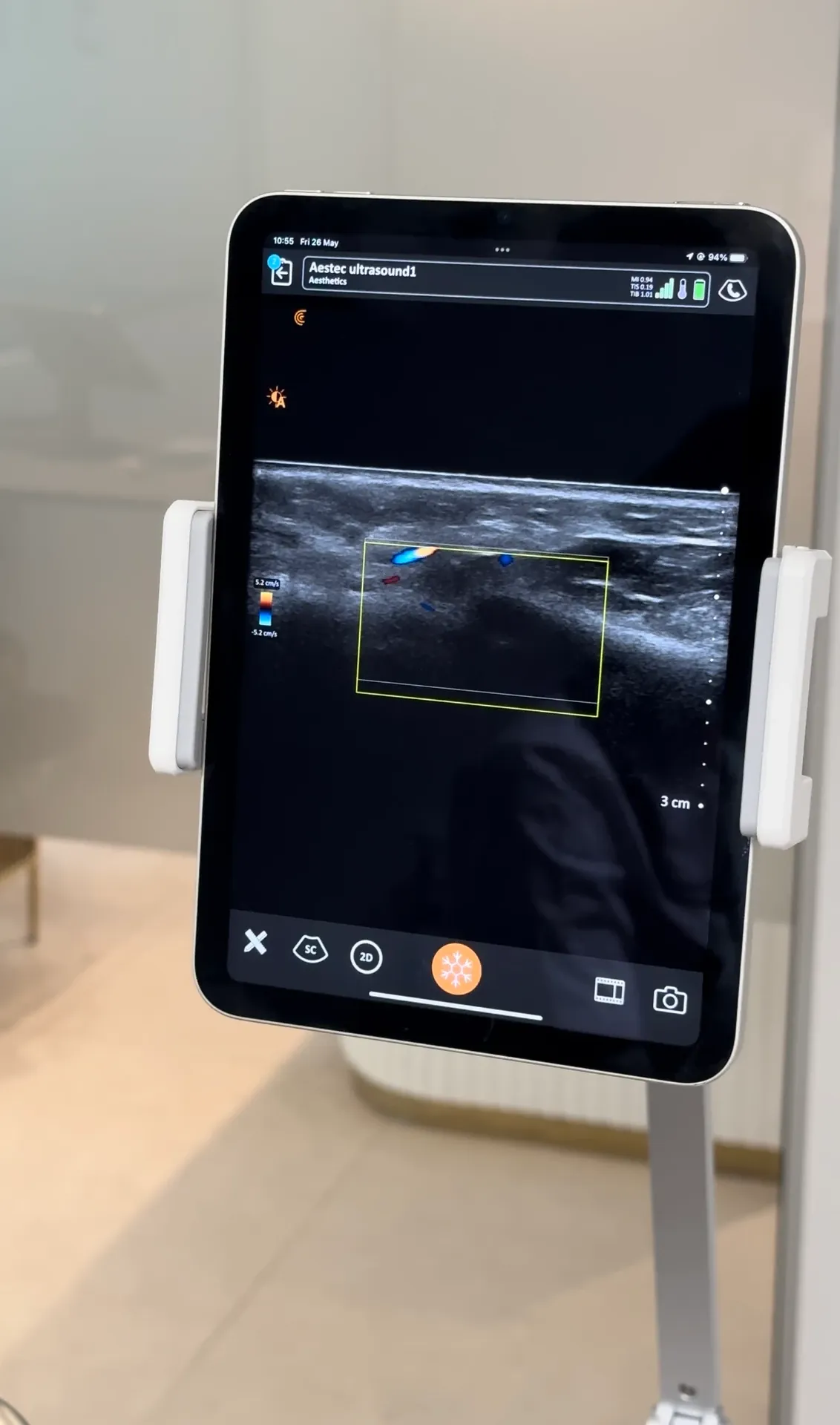 Ultrasound screen showing tissue layers