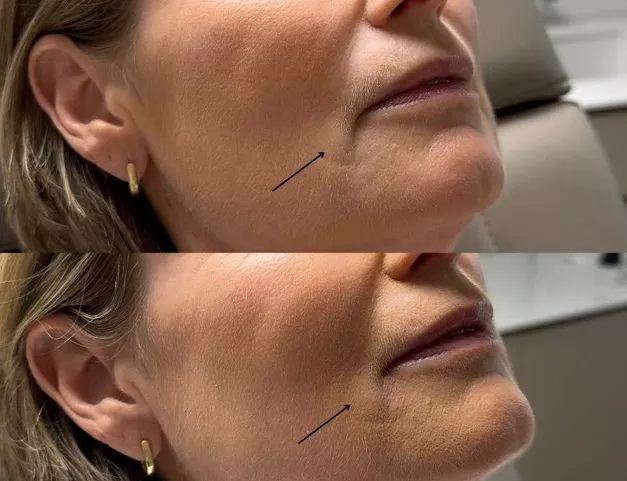 Drooping corners of the mouth, treatment and cause