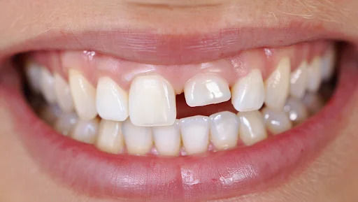 Diente roto, fisurado o astillado