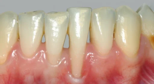 Recesiones gingivales