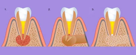 Apicectomía: salvando tu diente de infecciones persistentes