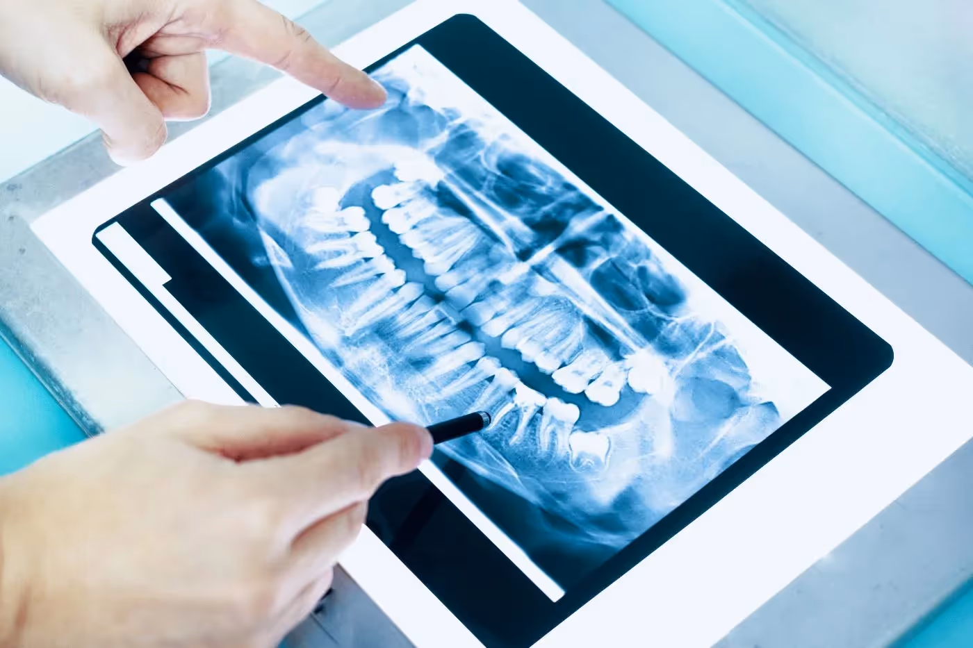Tooth Extractions in Vancouver