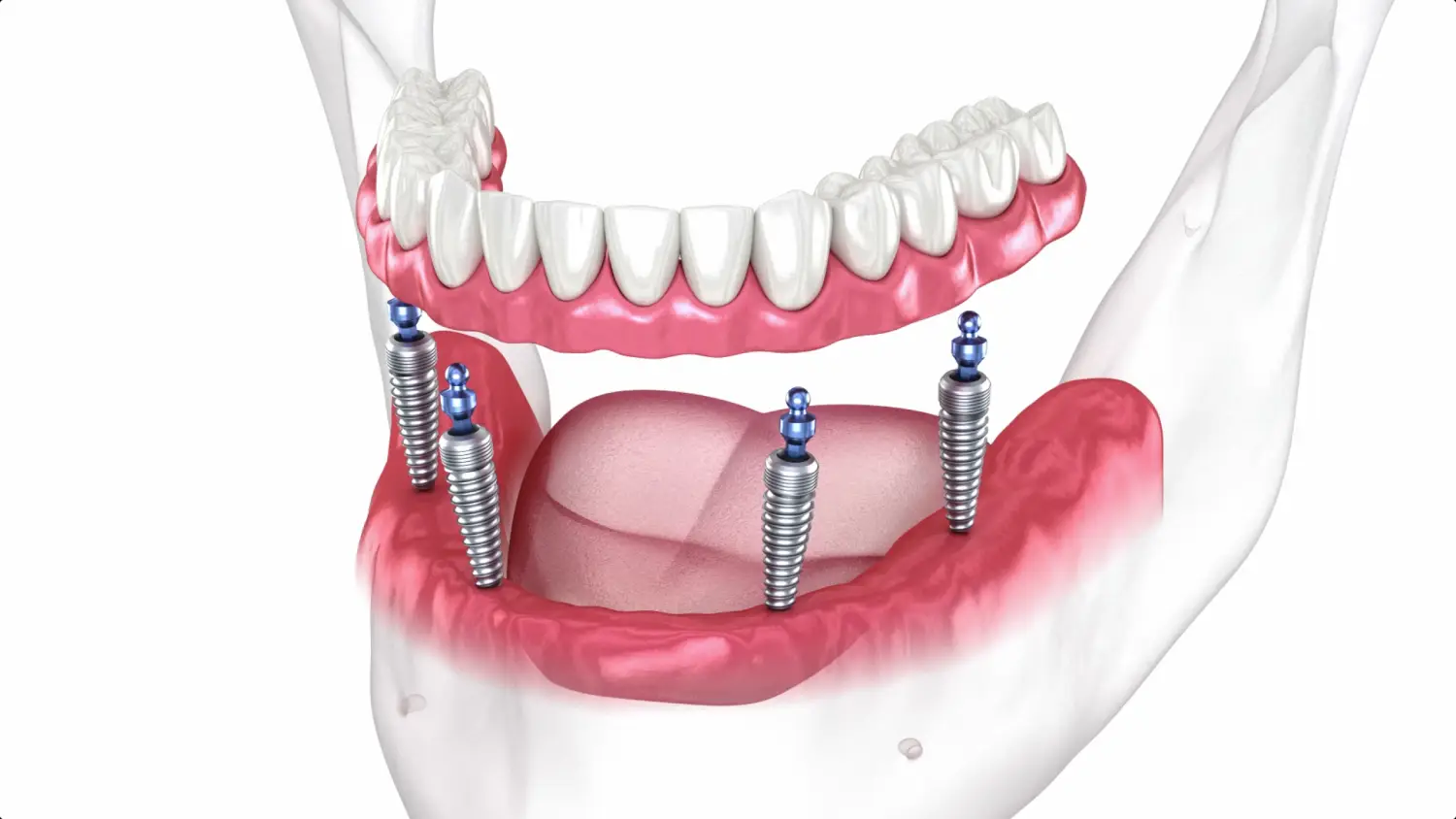All-on-4 Dental Implants