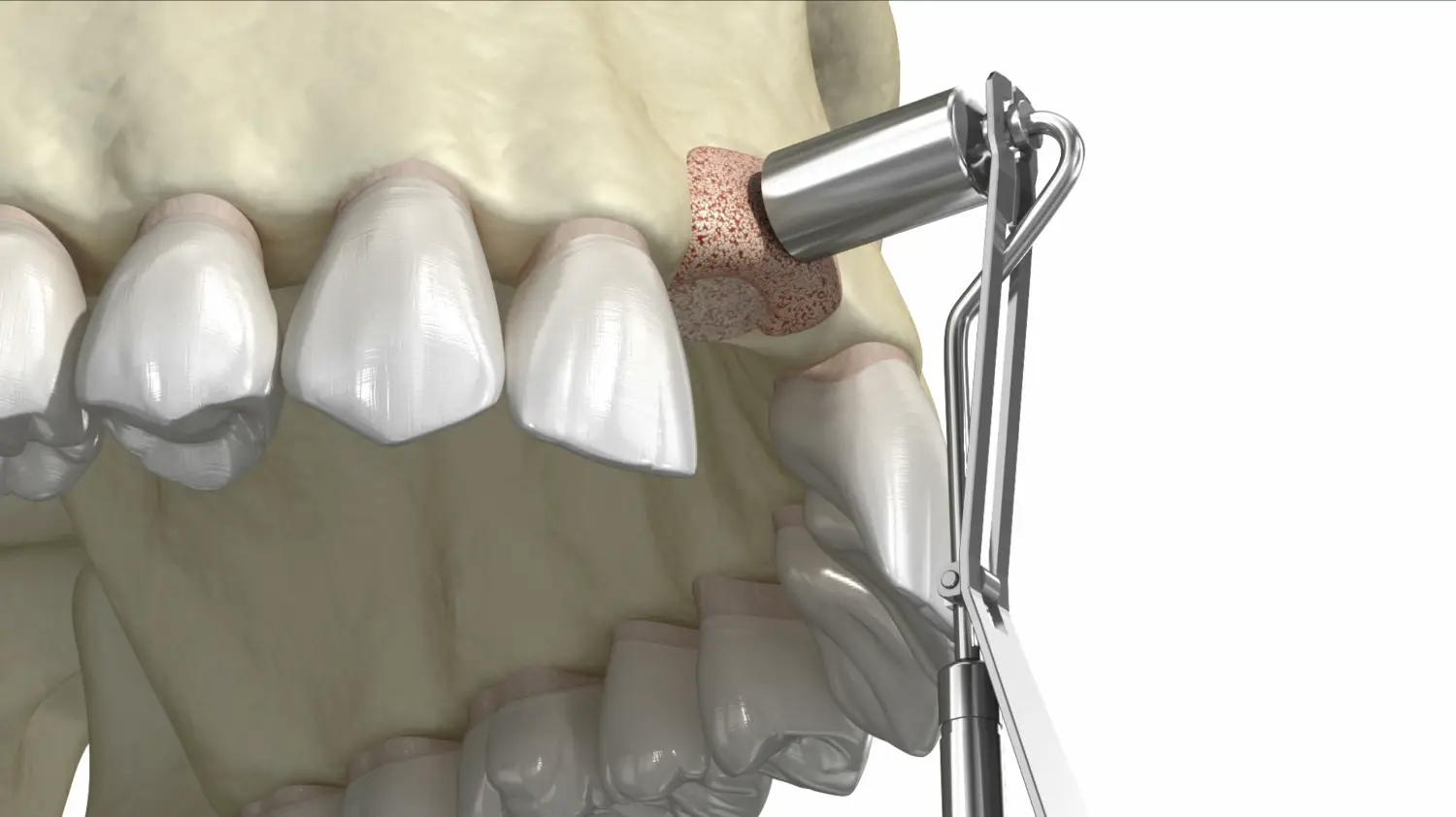 Bone Grafting