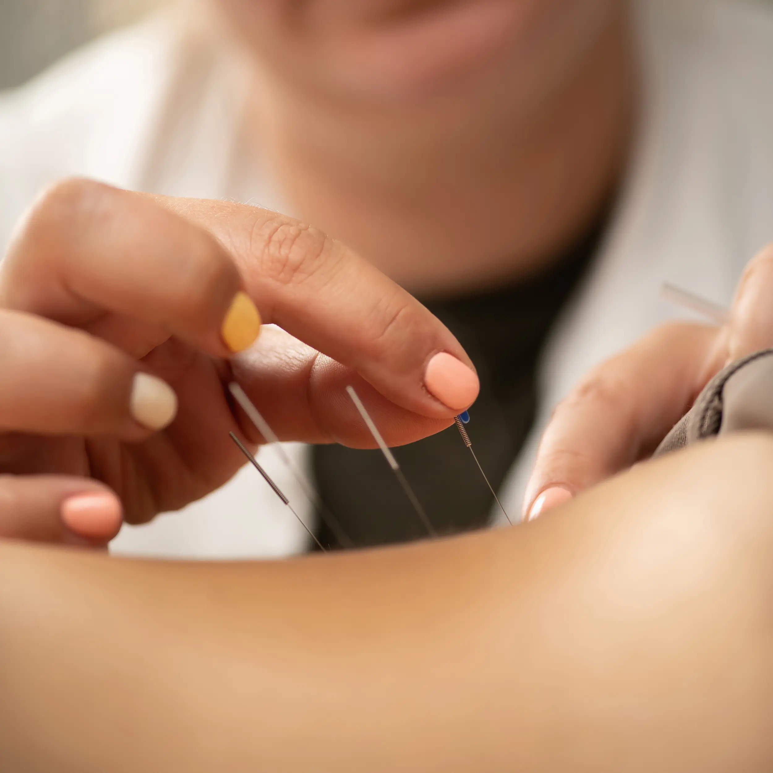 Doctor inserting acupuncture needles into patient's back