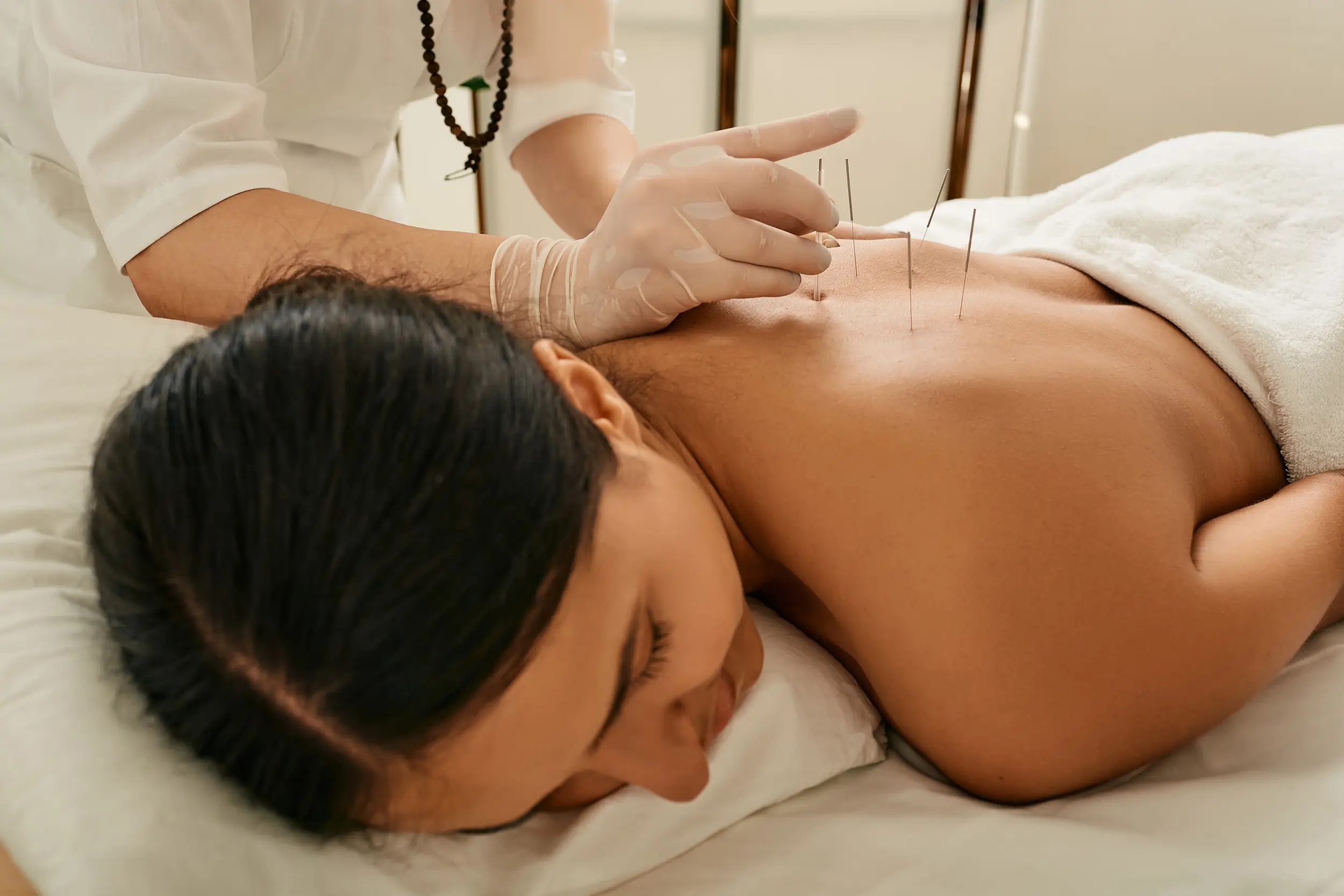 Relaxed woman laying down receiving acupuncture treatment