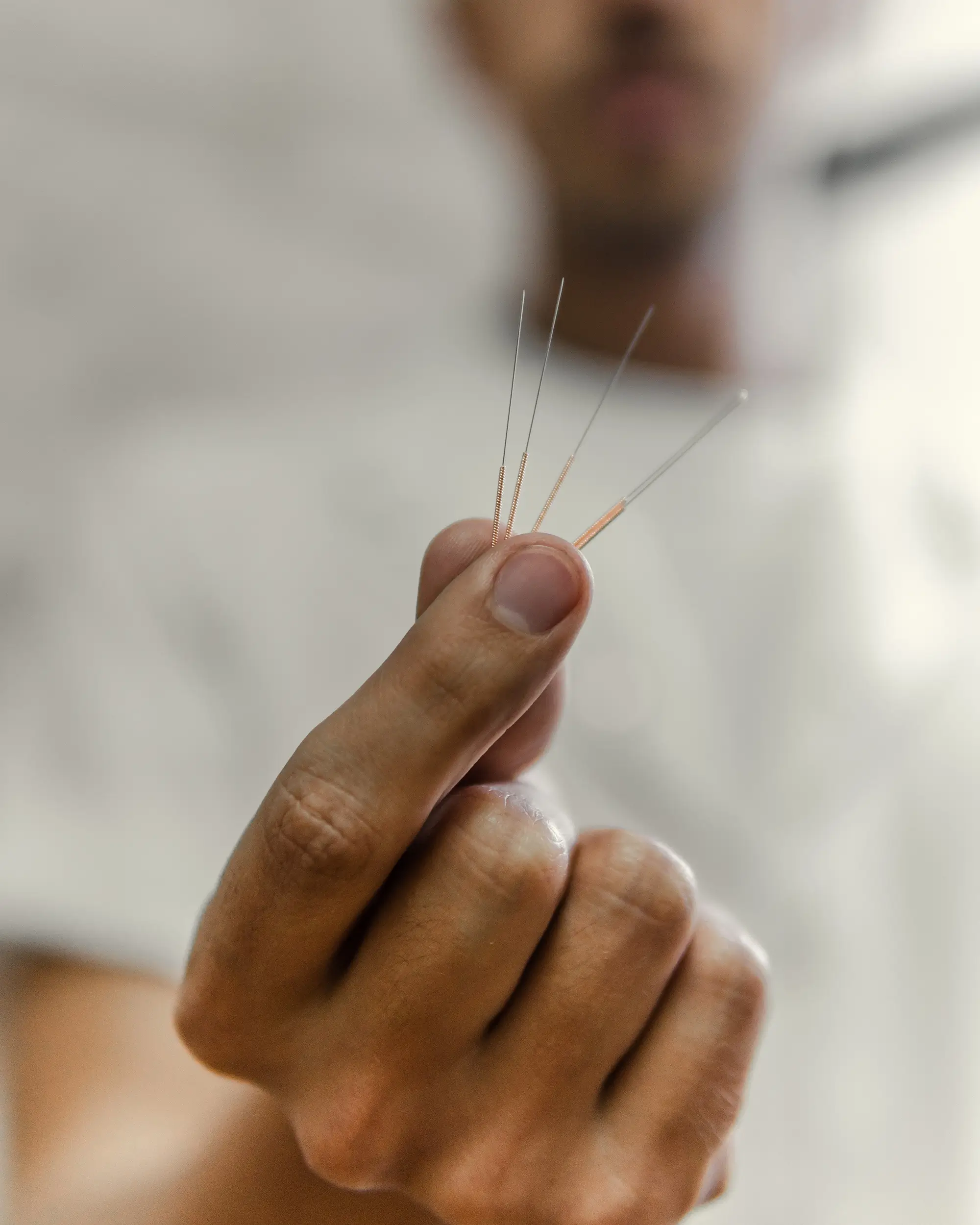 Male doctor hand showing acupuncture needles