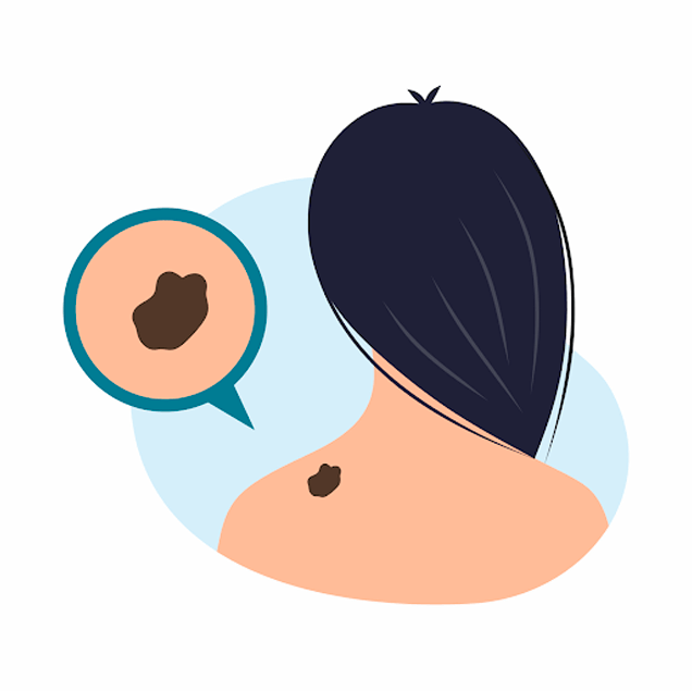 melanomas provocados