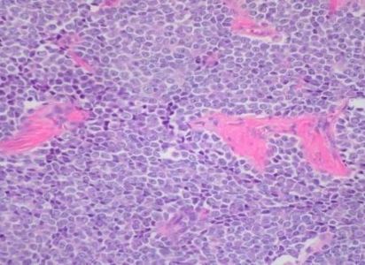 Investigadores en Barcelona identificaron por primera vez la célula que origina el sarcoma de Ewing