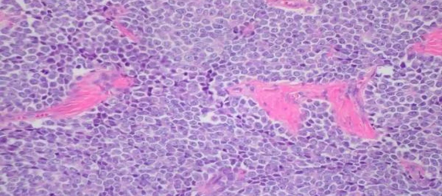 Investigadores en Barcelona identificaron por primera vez la célula que origina el sarcoma de Ewing