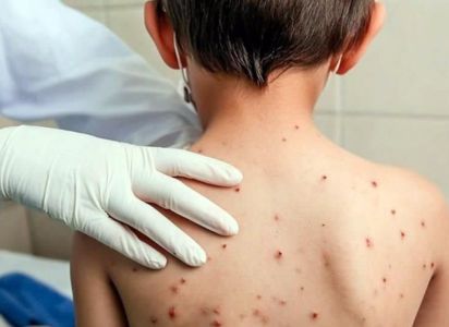 Perú activa alerta epidemiológica por alto riesgo de sarampión y polio