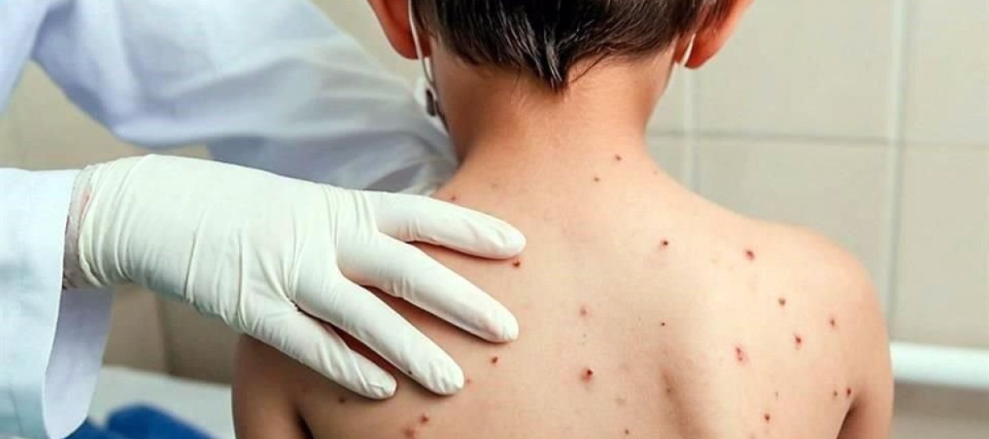 Perú activa alerta epidemiológica por alto riesgo de sarampión y polio