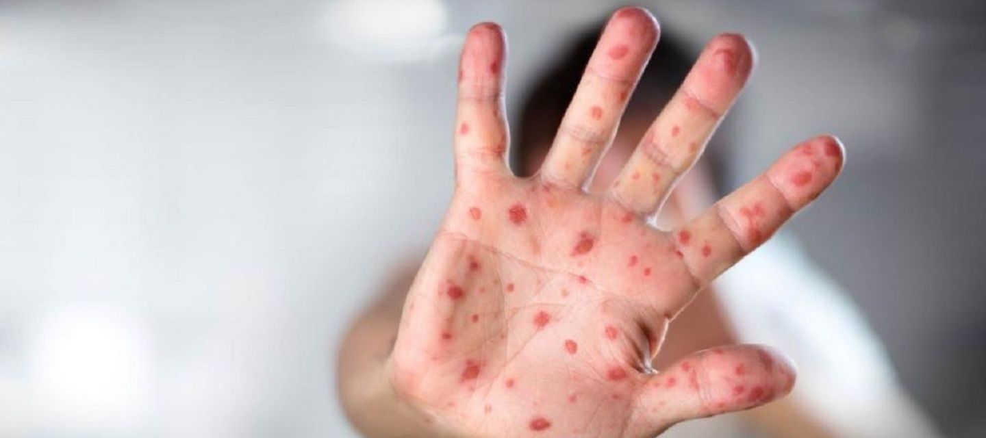 ‍México rebasa los 10.000 casos de sarampión y suma 31 muertes.