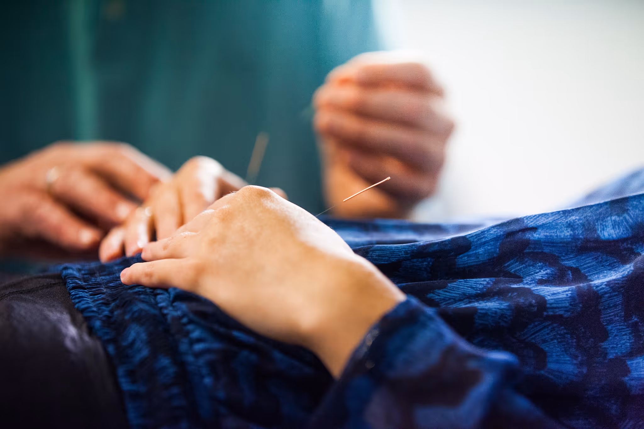 Nahaufnahme einer Hand während einer Akupunkturbehandlung in Berlin & Potsdam