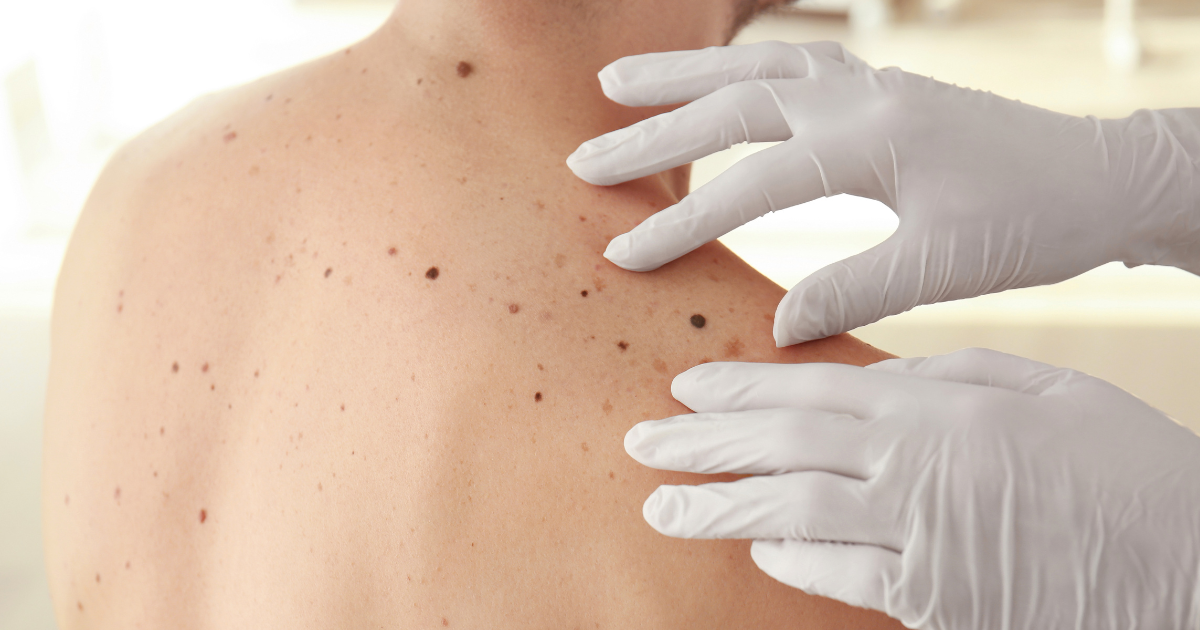 Médecin généraliste examinant un nævus au dermatoscope lors d'une consultation de repérage des cancers cutanés.