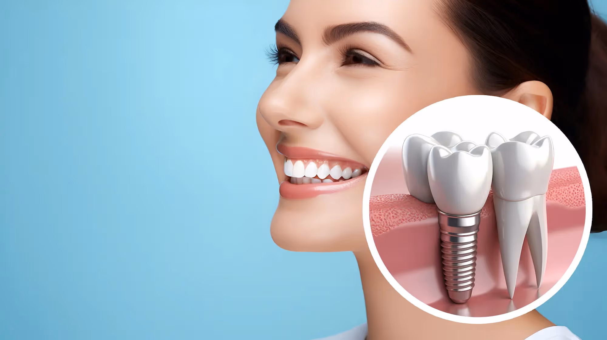 After Dental Implant Placement in Irvine, CA
