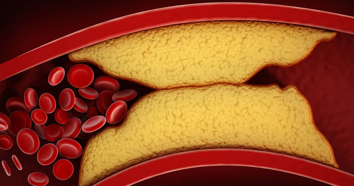 Flutuações nos níveis de colesterol aumentam risco de demência, aponta estudo da American Heart Association