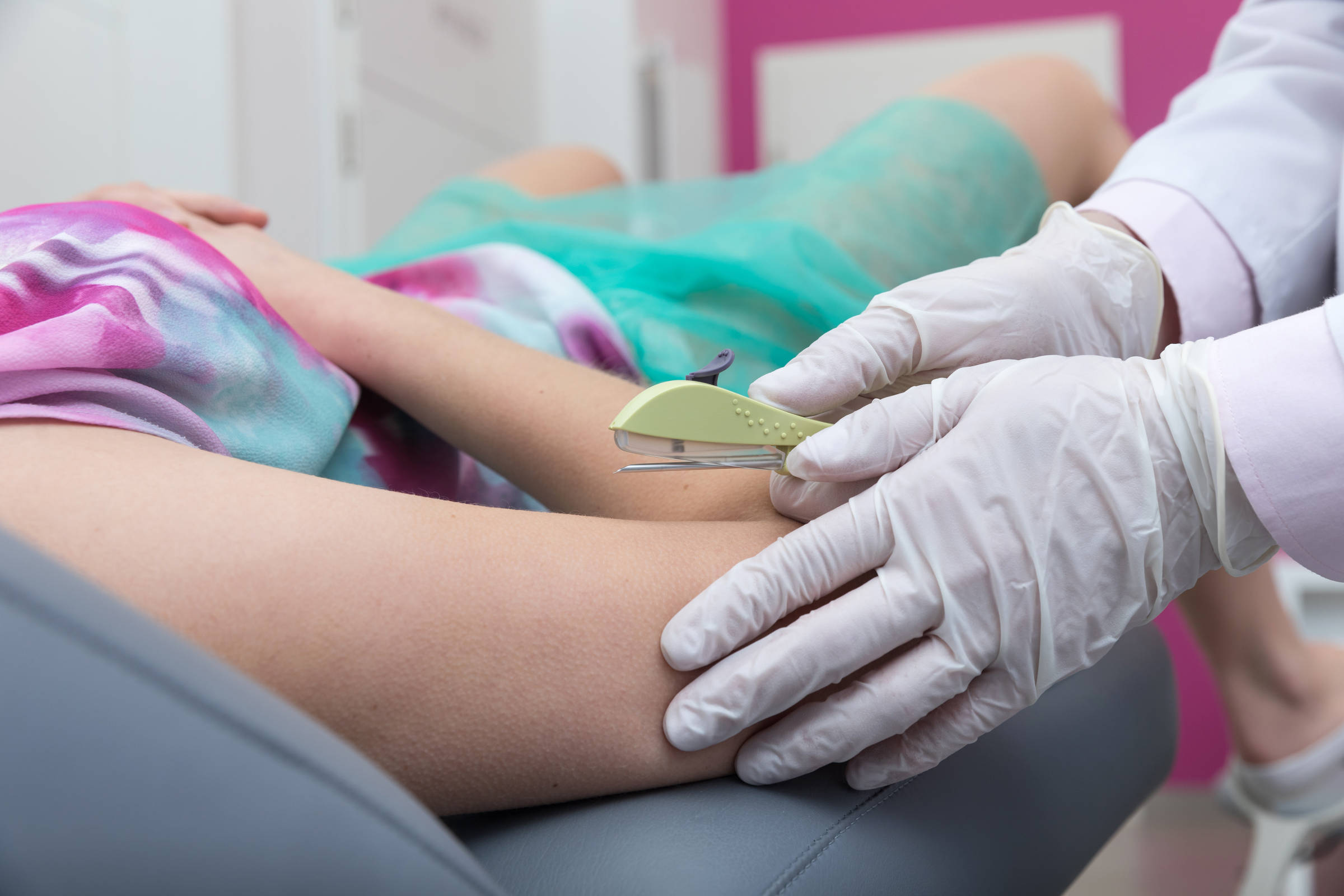 Implante hormonal Implanon será disponibilizado no SUS, prometendo eficácia na contracepção para milhares de mulheres