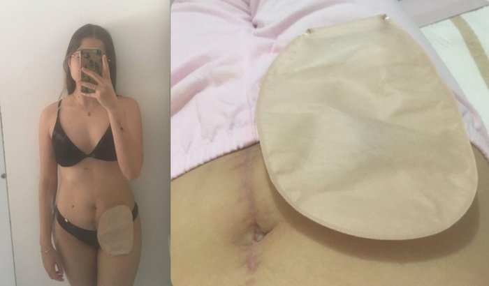 "Rafaella dos Santos Duarte lança vaquinha para custear cirurgia robótica de R$ 40.500,00 em Belo Horizonte"