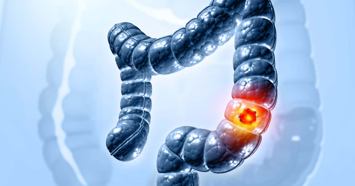 Consumo de carne vermelha está associado ao aumento do câncer colorretal em jovens, revela estudo da Cleveland Clinic